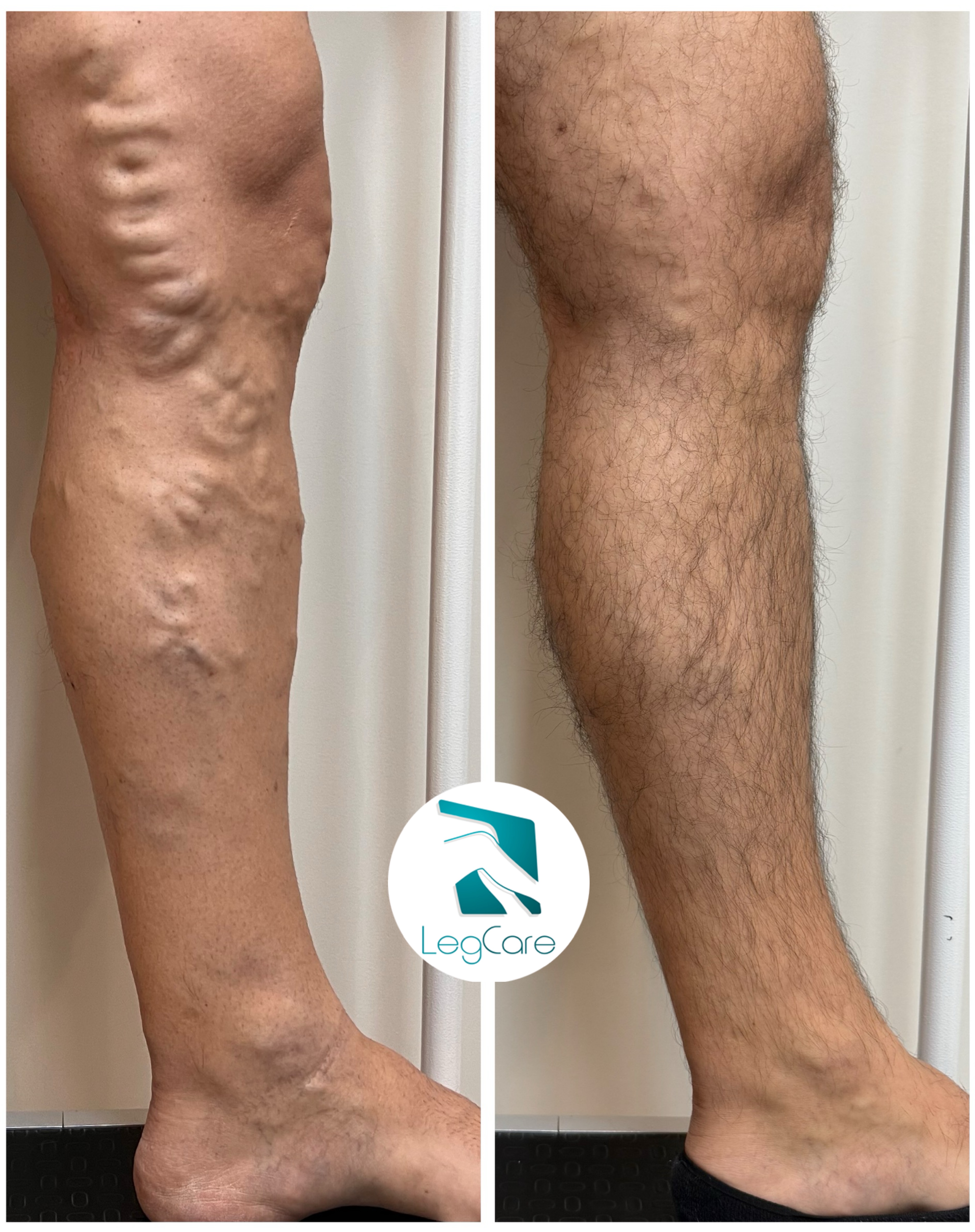 Comparações antes x depois