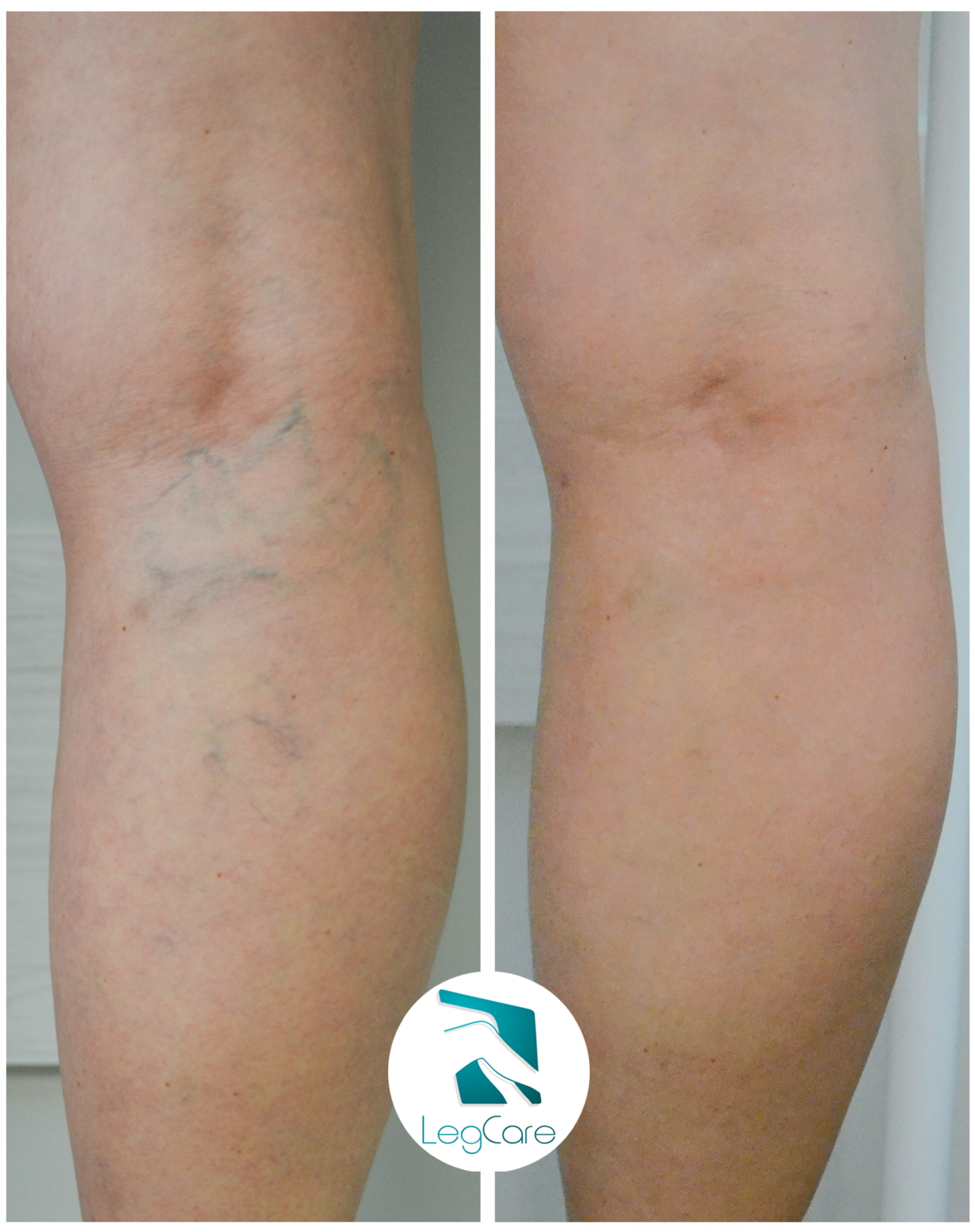 Comparações antes x depois