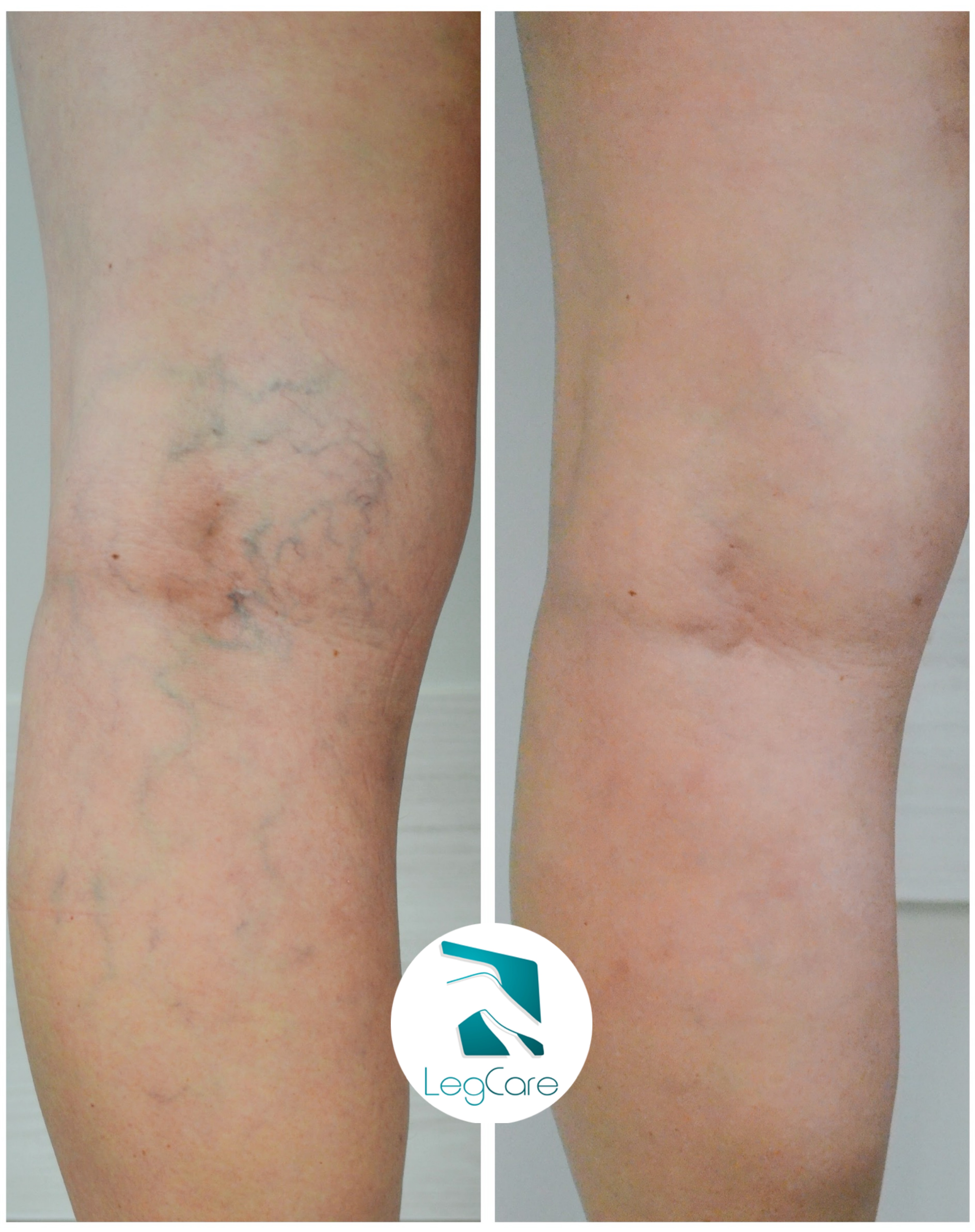 Comparações antes x depois