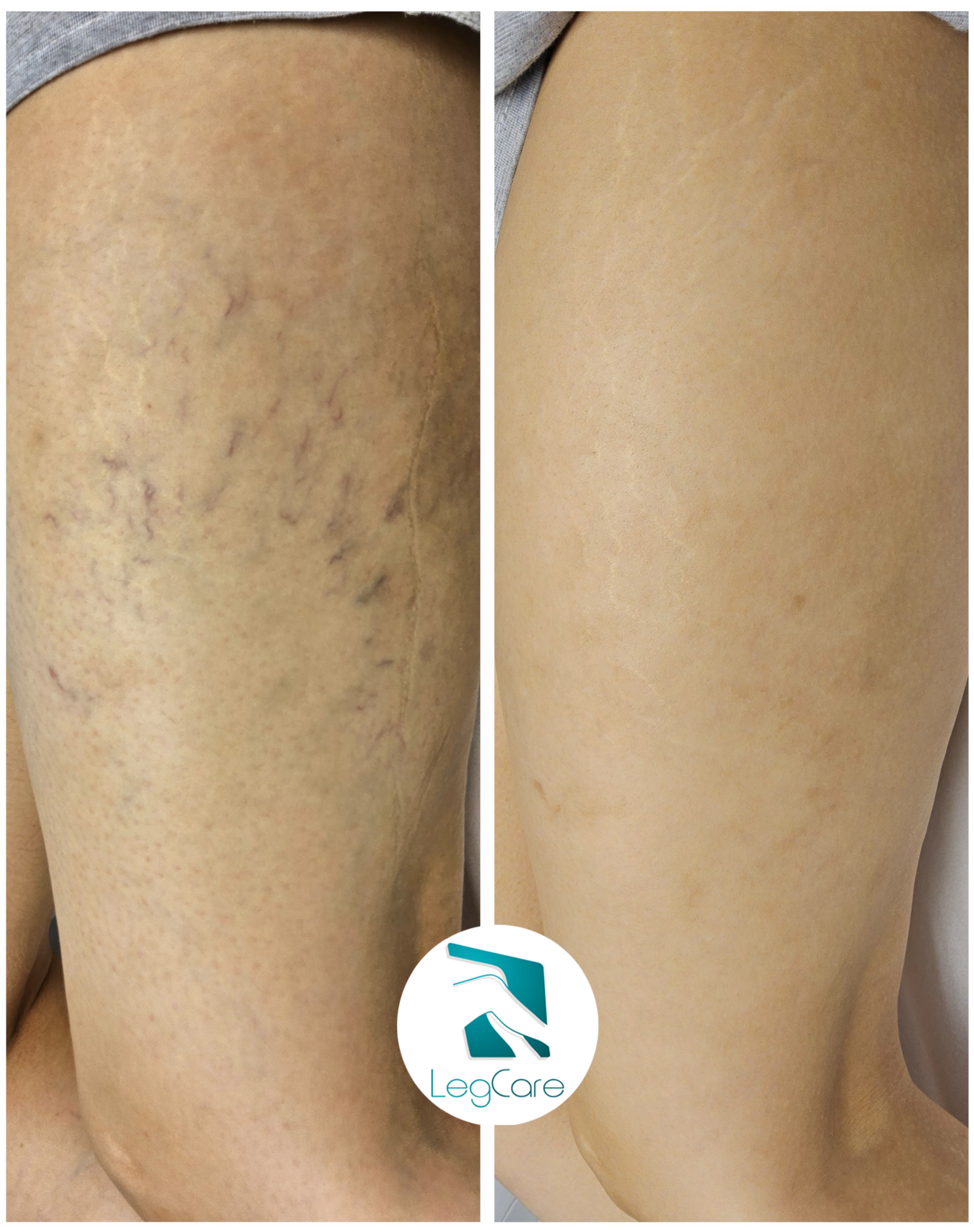 Comparações antes x depois