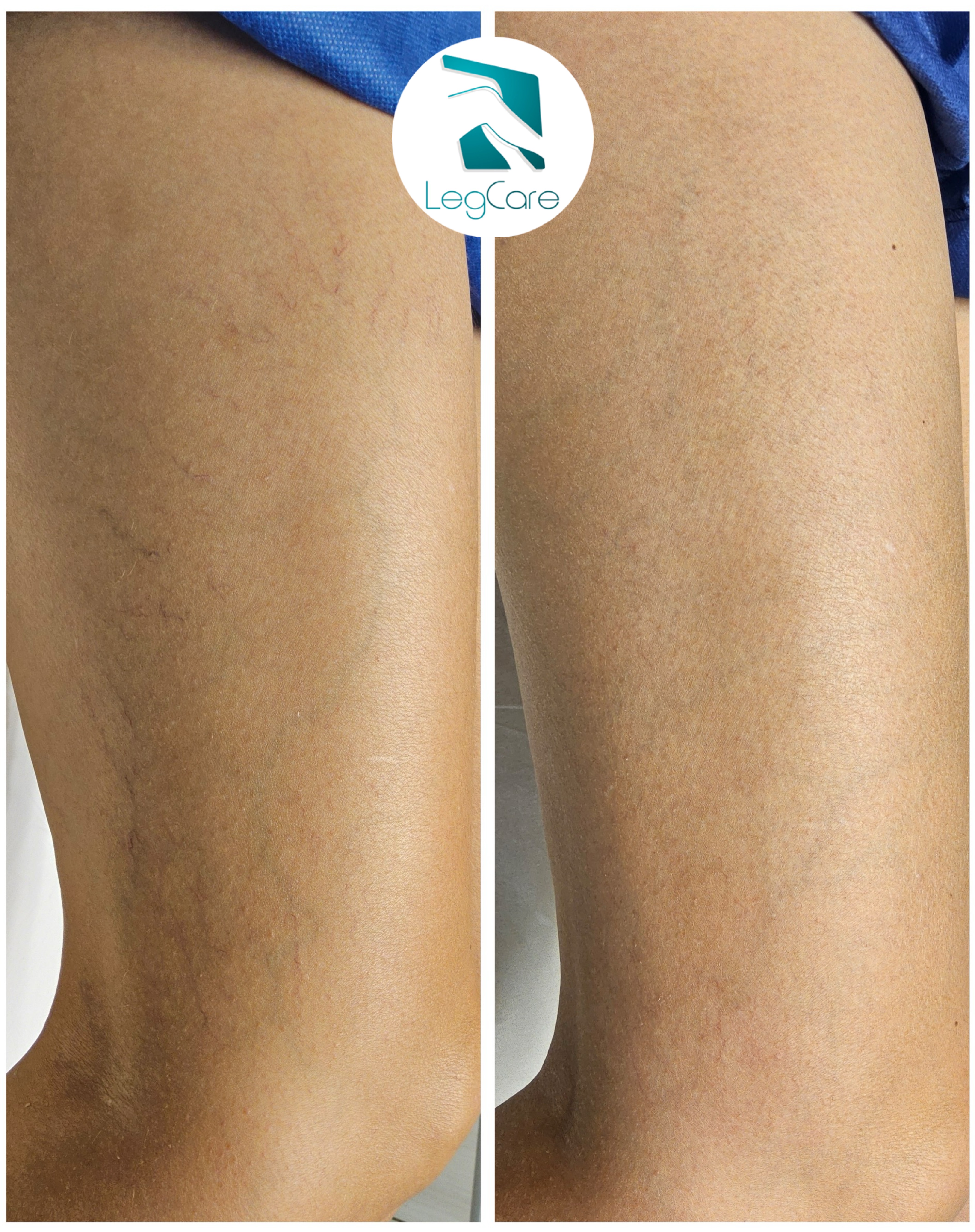 Comparações antes x depois