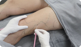 Microcirurgia de varizes