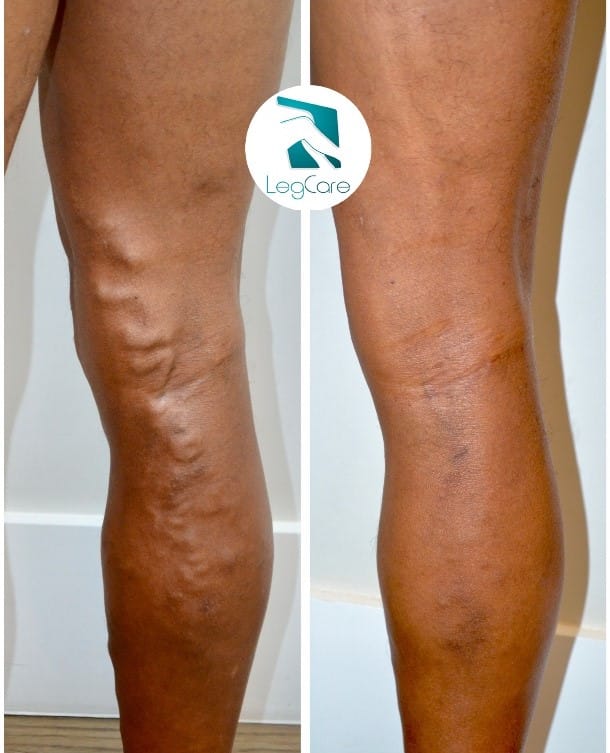 Comparações antes x depois